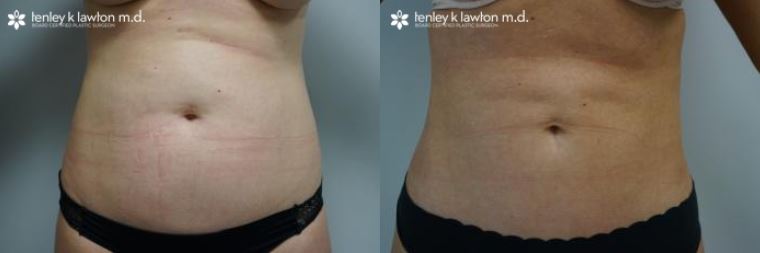 Can I Get A Second Tummy Tuck?