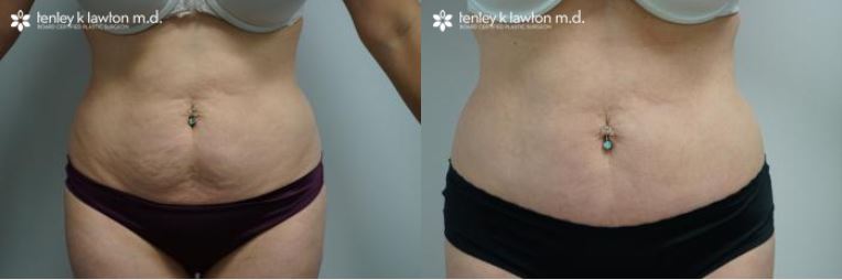 Good Candidate for a Tummy Tuck