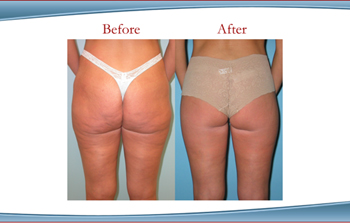 https://www.lawtonmd.com/wp-content/uploads/2020/09/Before_After_Buttock_Thigh_Lift_Case1S.jpg