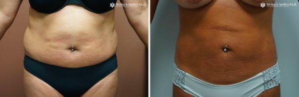 How Much Does Liposuction and A Tummy Tuck Cost - MCT