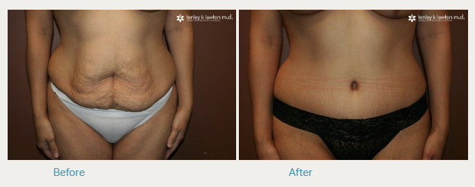 How Much Is a Tummy Tuck Cost In year 2020-2021?